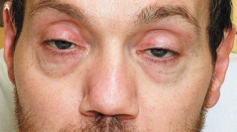 глаза героинового наркомана